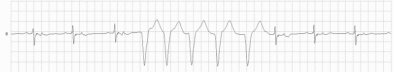 Idioventricular Rhythm Rhythm Strip